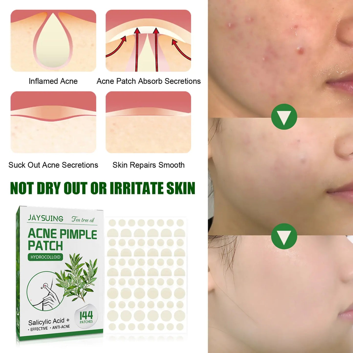 Blemish Busters: Acne Patches